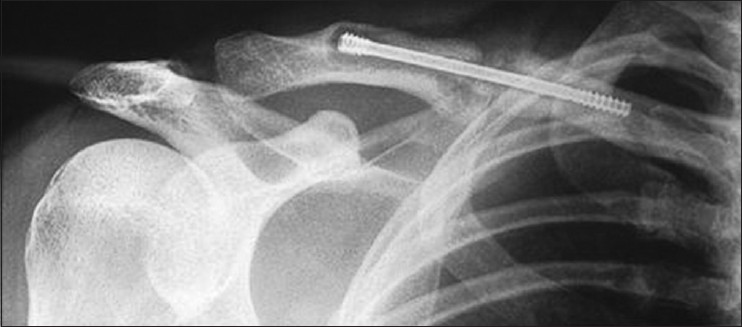 Figure 6: Hypertrophic non-union of the midshaft of the clavicle 5 months after operative treatment with 4.5 × 75 mm Herbert cannulated bone screw. There is a clear zone of lucency around the leading head
of screw