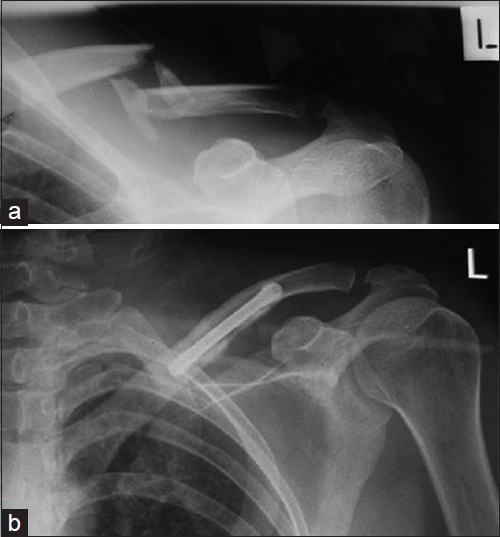 Figure 4: (a) A 30-year-old lady sustained a displaced comminuted fracture of right clavicle due to a fall. (b) Postoperative radiograph shows restoration of clavicle alignment. Precise anatomic reduction is one of the advantages of intramedullary fixation of clavicle fracture using cannulated Herbert screw