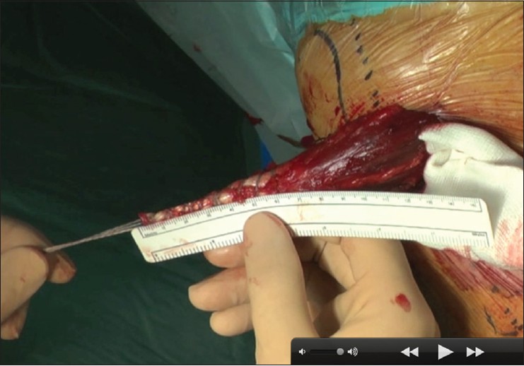 Figure 3: We normally achieve a tubular tendon measuring about 7 mm in diameter and 7 cm in length