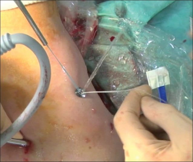 Figure 5: Endobutton is introduced through the incision used for positioning of the guide. Tension is maintained while the device is fixed
