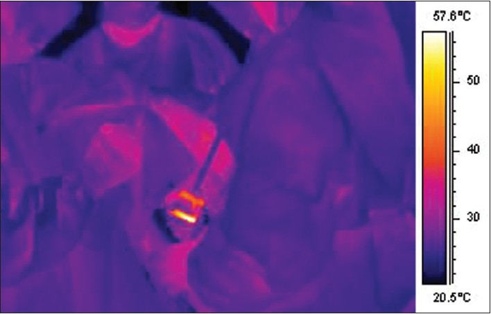Figure 2: Calibrated infra-red thermal image during proximal humeral reaming in patient with osteoarthritis