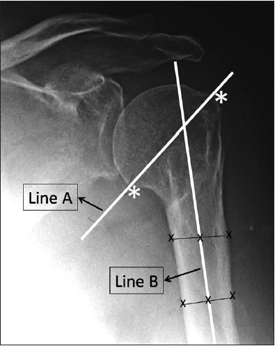 Figure 1: Measurement of humeral neck-shaft angle. Line A is drawn between the tuberculum majus and inferior joint surface (asterisks) and represents the alignment of the neck. Line B represents the alignment of the humeral shaft. Neck-shaft angle is defined as the angle between the Line A and Line B