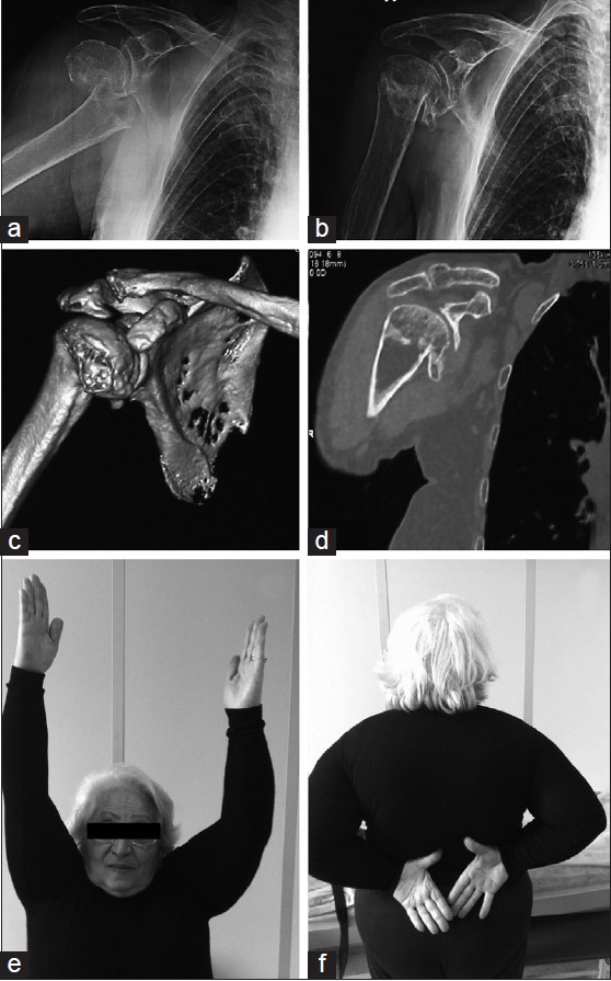 Figure 2: A 79-year-old female patient with Neer type two-part fracture. (a) Initial shoulder antero-posterior shoulder radiograph. (b) Final follow-up radiograph. (c) 3D computerized tomography (CT) and (d) coronal CT reconstruction. (e and f) Clinical appearance of the patient at the final follow-up at 22 months