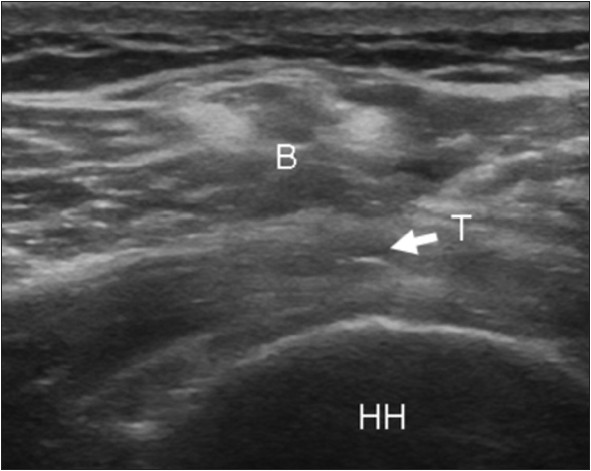 Figure 6: Ultrasound image of a fully healed supraspinatus tendon in a patient with previous zone 3 retraction (B = Bursa; T = Tendon; HH = Humeral Head; Arrow: pointing towards tendon).
