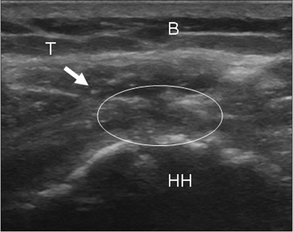 Figure 7: Ultrasound image of a fully torn supraspinatus tendon in a patient with previous zone 4 retraction. (B = Bursa; T = Tendon; HH = Humeral Head; Arrow: pointing towards tendon; Circle: delineating area between tendon stump and greater tuberosity).