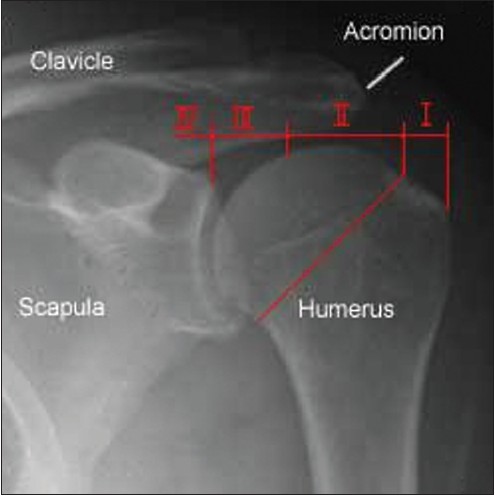 Figure 1: Grashey view of the retraction zones of supraspinatus tears of the rotator cuff, against a normal x-ray of the left shoulder.