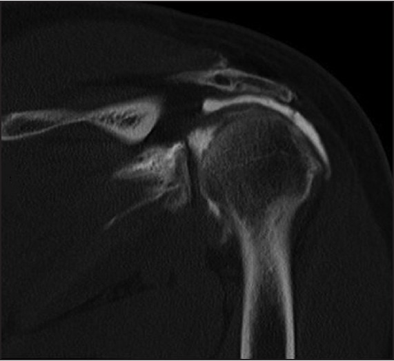 Figure 2: Coronal oblique view T1 view of a massive left rotator cuff tear of the supraspinatus demonstrating retraction of the tendon to the level of the glenoid.