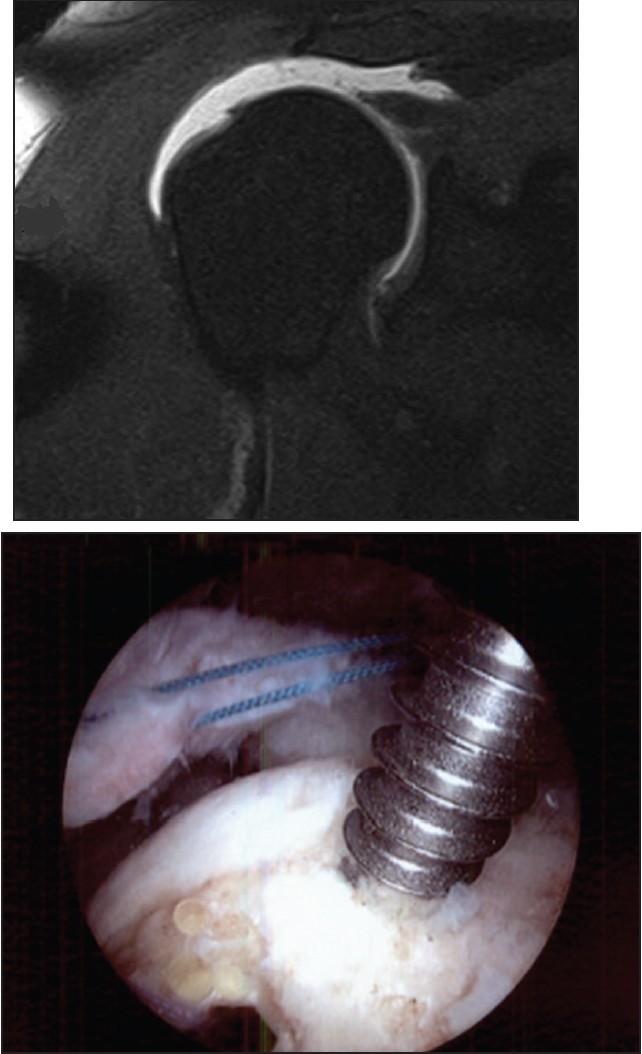 Figure 3 a: Coronal T1 view of a full-thickness tear of the supraspinatus, retracted beyond the level of the glenoid (stage IV); 3b: Arthroscopic image of the same patient showing a traction suture pulling the massively retracted rotator cuff tear.