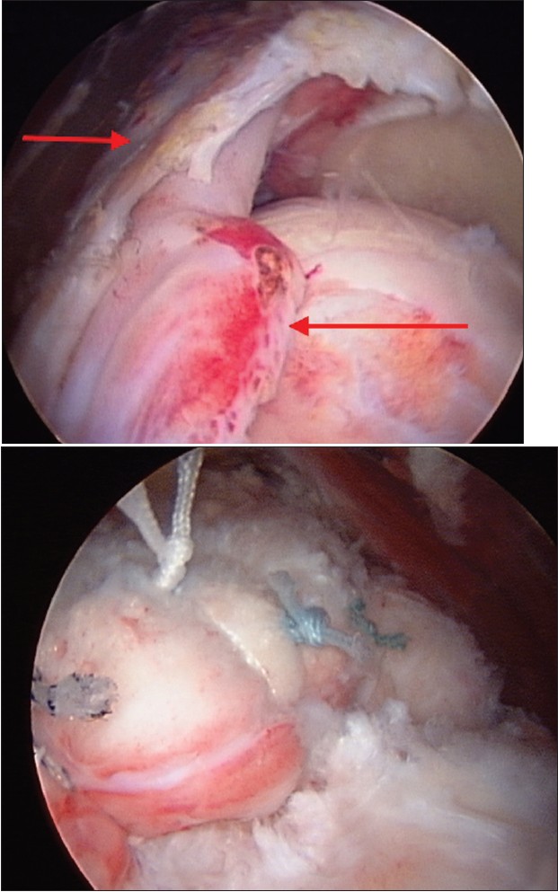 Figure 4 a: Arthroscopic view of a right shoulder with a massive rotator cuff tear of the supraspinatus extending into the infraspinatus;  4b: Arthroscopic view of the same shoulder, after a suture anchor repair.