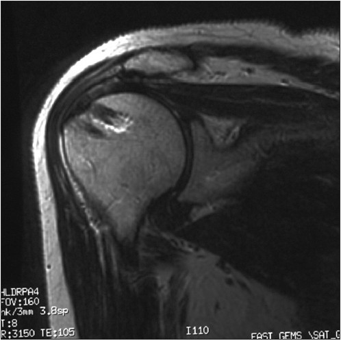 Figure 5: Coronal image of repaired right rotator cuff.