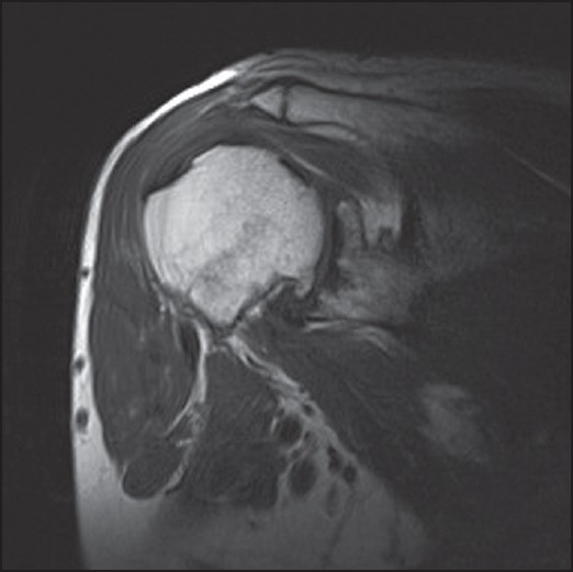 Figure 1: T2 weighted coronal MRI scan showing intact rotator cuff with muscle belly of normal signal and volume