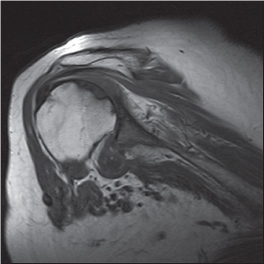 Figure 2: T2 weighted coronal MRI scan showing abnormal increased signal in the distal supraspinatus tendon which appears to be thinned and compressed with no definite tear or tendon retraction seen