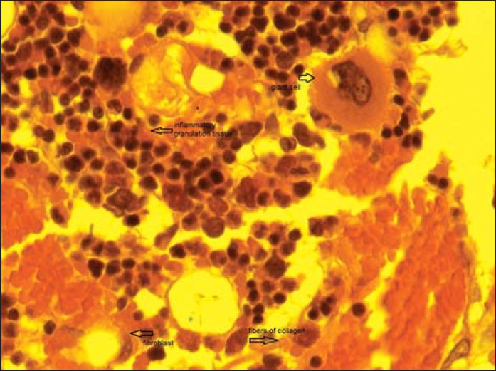 Figure 5: Nonpatch group 6 weeks. Giant cells, inflammatory granulation tissue, fibers of collagen, fibroblasts