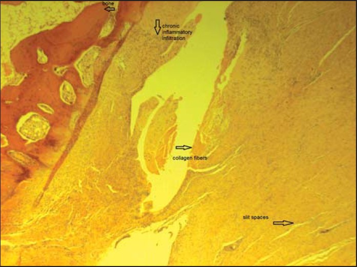 Figure 6: Patch group 6 weeks. Bone, collagen fibers, chronic inflammatory infi ltration, slit spaces, filled by fi brin