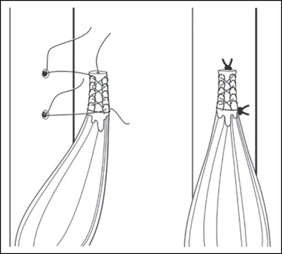 Figure 1: Dual suture anchor biceps tenodesis construct (Two Mitek G4 suture anchors (Mitek, Norwood, MA) each loaded with a No. 2 Fiberwire (Arthrex, Naples, FL) suture with one in Krackow stitch pattern and the other in a Bunnell stitch pattern)