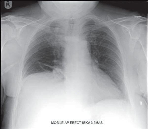 Figure 1: Radiograph of the patient with elevation of the right hemidiaphragm indicating right side phrenic nerve paresis