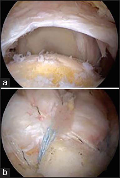 Figure 1: Rotator cuff repair using a knotless suture-bridge fi ber tape technique (a) before, (b) after