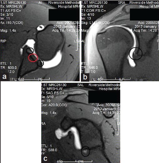 Figure 7: Selective magnetic resonance imaging demonstrating an inferior labral tear and inferior paralabral cyst, which has been seen in inferior labral tear. An axial image (a) shows and inferior labral tear (red circle) with clear extension anteriorly and posteriorly (black circles). A coronal view (b) demonstrating inferior labral tear (circle). A sagittal view (c) demonstrating an inferior paralabral cyst (circle)