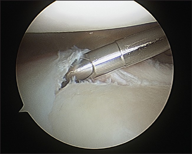 Figure 1: View from anterior-superior portal identifying inferior labral tear and preparation of the glenoid surface at the 6 o'clock position