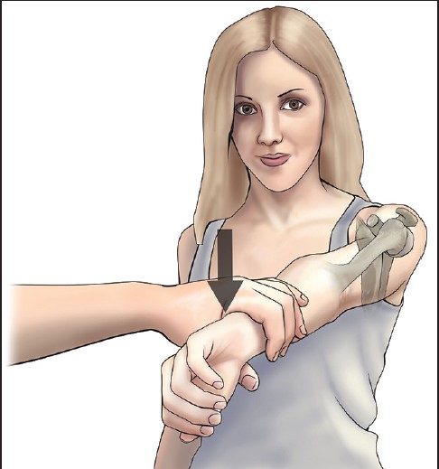 Figure 1: During O'Brien's test the posterior capsule is tight with anterior laxity and the line of pull of the deltoid during the test translates the humeral head posteriorly