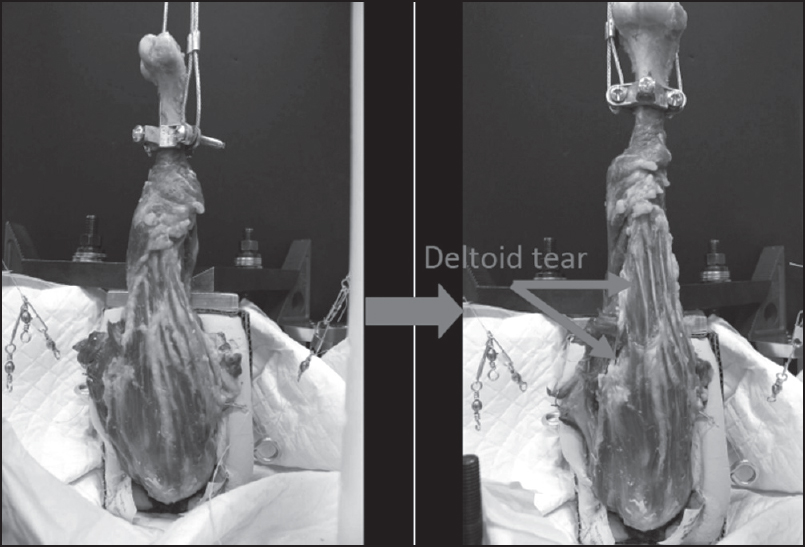 Figure 3: Specimen after load to failure showing anterior deltoid detachment