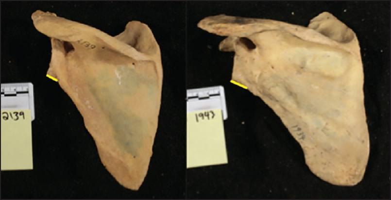 Figure 4: Short versus long necked scapula