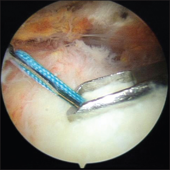 Figure 10: Arthroscopic view of an antegrade suture passage through the rotator cuff tendon demonstrating an oblique penetration of the needle. Note that the device (ExpresSew II) had an open-type window on the superior arm of the grasping component. In closed-window devices the needle occasionally jammed on the front bar of the window during rotator cuff repair and during trials in this study