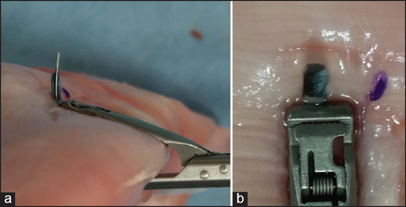 Figure 3: A needle passage with suture is depicted using the Arthrex Scorpion, however, the needle passed in front of the superior arm of the grasping component. (a) Lateral view; (b) superior view