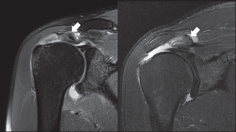Figure 4: Two magnetic resonance imaging scans of rotator cuff tears with a delaminated torn end of the tendon thicker than 10 mm (measured with imaging software)