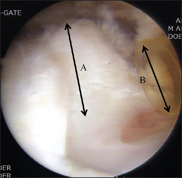 Figure 5: Arthroscopic view of a high-grade bursal side rotator cuff tear showing that the torn end of the tendon (a) was thicker than the 8 mm diameter cannula (b)