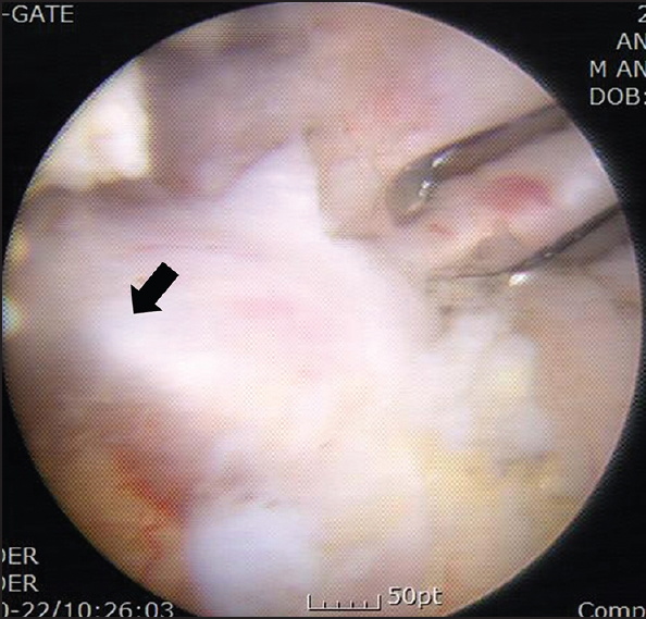 Figure 6: Arthroscopic view of a rotator cuff tendon repair showing an unsuccessful antegrade needle passage. In this case, the tendon was thick and the needle penetrated at an acute angle such that the needle point slid far in front of the superior grasping window without emerging from the tendon (arrow)