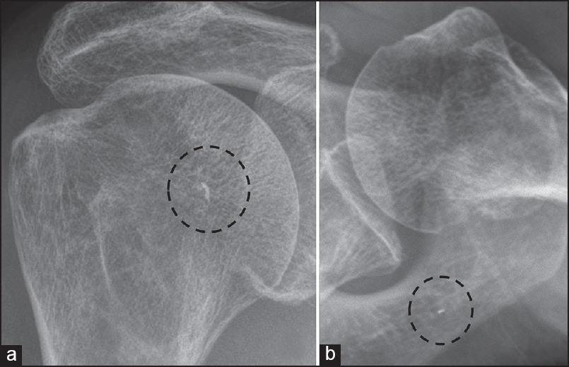 Figure 7: (a) Anterior-posterior and (b) axillary lateral radiographs showing a broken needle tip (inside dotted circle) that could not be removed from the rotator cuff tendon
