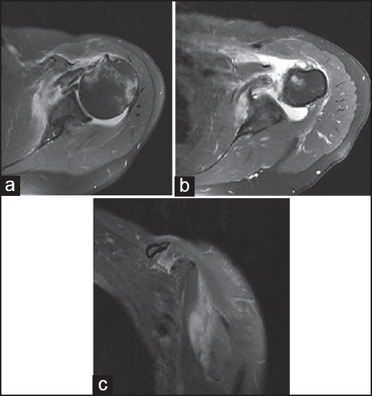 Figure 2: (a) (Axial magnetic resonance imaging [MRI]) demonstrates subscapularis tear, long head biceps tendon dislocation, coracobrachialis tear, and subchondral humeral head edema. (b) Demonstrates intra- and extra-articular hematoma due to torn, retracted subscapularis and coracobrachialis. (c) (Coronal MRI) demonstrates full-thickness coracobrachialis tear with medial distraction