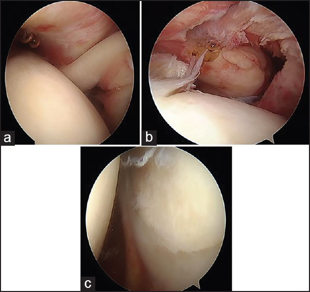 Figure 3: (a) (Arthroscopic) demonstrates the long head of biceps tendon medially dislocated out of the rotator interval's intertubercular groove. (b) (Arthroscopic) demonstrates the subscapularis torn off the lesser tuberosity footprint, retracted medially. (c) (Arthroscopic) demonstrates the inferior labrum injury from 7 to 3-o'clock