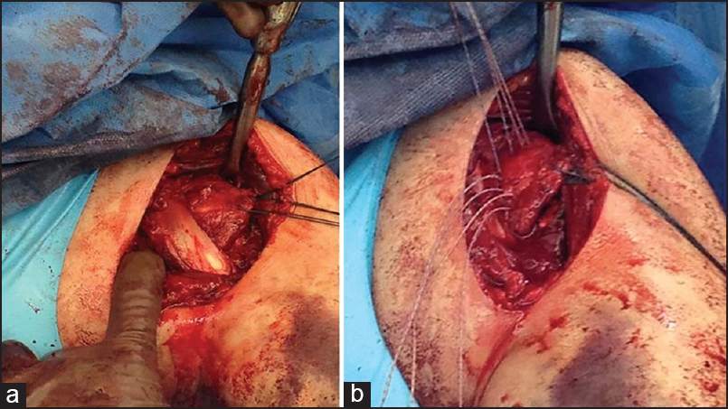 Figure 4: (a) (Intraoperative photograph) demonstrates the open deltopectoral exposure with tag sutures in torn subscapularis tendon, and the torn/retracted coracobrachialis where the surgeon's finger is inserted. (b) (Intraoperative photograph) demonstrates the open the medial row of suture anchors placed in subscapularis