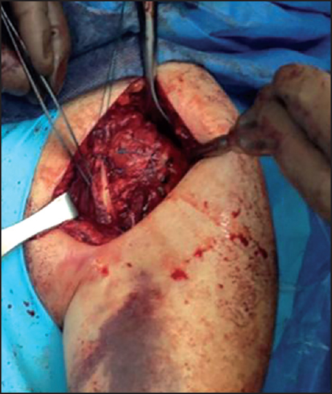 Figure 5: This figure demonstrates the open deltopectoral exposure of the left shoulder with the completed repair of the subscapularis with medial and lateral row of suture anchors and coracobrachialis tenodesis to the short head of biceps tendon
