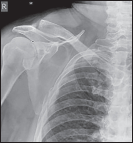 Figure 1: Anteroposterior radiograph of the right shoulder showing a displaced Ideberg type III fracture of the gleniod, with some ipsilateral rib fractures