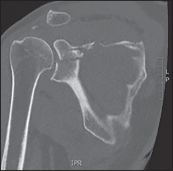 Figure 2: Coronal computed tomography scan image of the right shoulder revealing a 5 mm intra-articular step in the gleniod surface