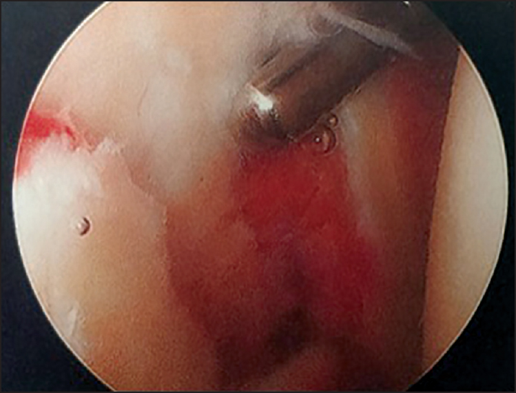 Figure 3: Intraoperative arthroscopic picture showing the comminuted glenoid fracture with signifi cant articular step. Arthroscopy can allow a much clearer view of the fracture site than is seen in open surgery
