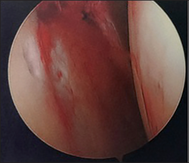 Figure 4: Arthroscopic image taken after reduction of the glenoid fracture using the coracoid as a reduction tool