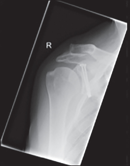 Figure 5: X-rays taken 7 weeks postoperatively show a well-united fracture with adequate articular reduction. Anteroposterior radiograph 7 weeks postoperative