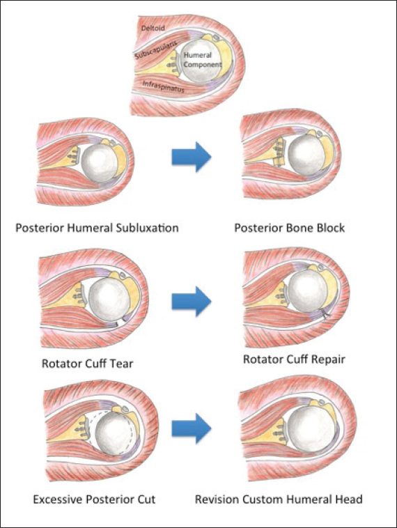 Figure 5: Causes and treatment options for posterior instability
