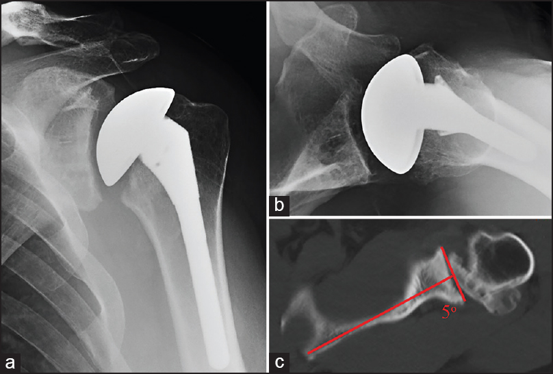 Figure 1: Grade A seating - Immediate postoperative anteroposterior radiograph (a), axillary radiograph (b), and preoperative axial computed tomography scan with measured retroversion (c) illustrating an example of Grade A glenoid seating following total shoulder arthroplasty