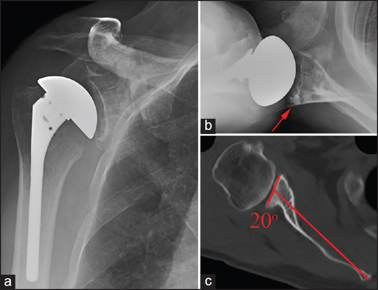Figure 2: Grade B seating - Immediate postoperative anteroposterior radiograph (a), axillary radiograph (b), and preoperative axial computed tomography scan with measured retroversion (c) illustrating an example of Grade B glenoid seating following total shoulder arthroplasty. Preoperative retroversion was incompletely corrected, leaving an uncontained area of the posterior glenoid which was filled with cement (red arrow). Incomplete contact was noted in just over 25% of the glenoid seen on the axillary radiograph