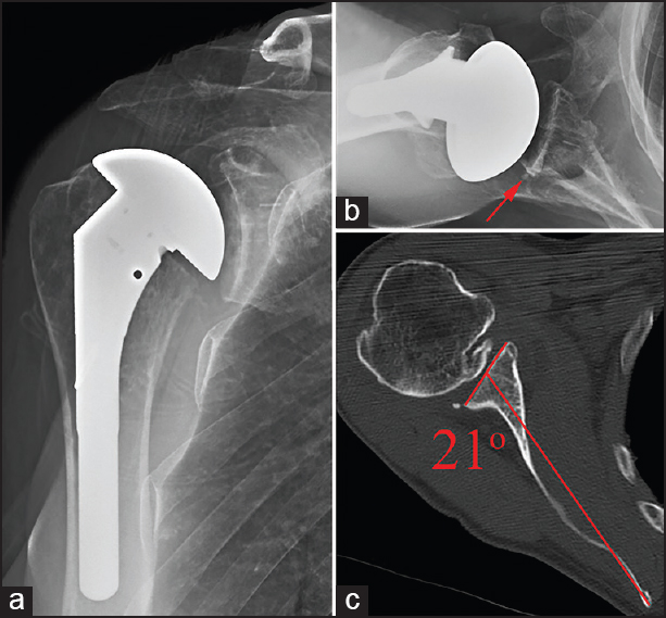 Figure 3: Grade C seating - Immediate postoperative anteroposterior radiograph (a), axillary radiograph (b), and preoperative axial computed tomography scan with measured retroversion (c) illustrating an example of Grade C glenoid seating following total shoulder arthroplasty. Preoperative retroversion was incompletely corrected, leaving an uncontained area of the posterior glenoid which was filled with a wedge of cement (red arrow) encompassing just under 50% of the glenoid surface seen only on the axillary radiograph