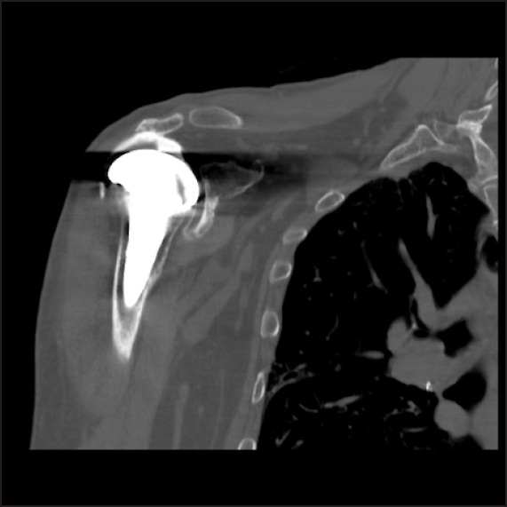 Figure 2: Computed tomography arthrogram of the right shoulder in a 67-year-old male demonstrating superior migration of the humeral component as well as contrast extravasation in the subacromial space indicative of a full-thickness tear of the superior rotator cuff