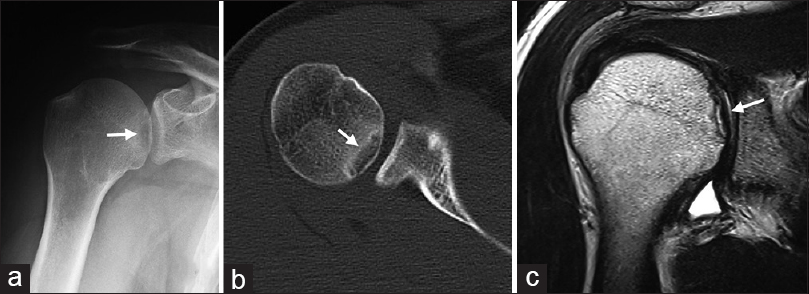 Figure 1: Preoperative imaging findings. (a) Antero-posterior plain radiogram shows the radiolucent lesion in the medial aspect of the right humeral head (white arrow). (b) Axial computed tomography scans show the 2-cm radiolucent lesion surrounded by osteosclerotic change, whereas the subchondral bone maintains its continuity above the lesion (white arrow). (c) Magnetic resonance imaging shows an osteochondral fragment, which is separated from the humeral head, on T2-weighted images. The articular cartilage maintains its continuity (white arrow)