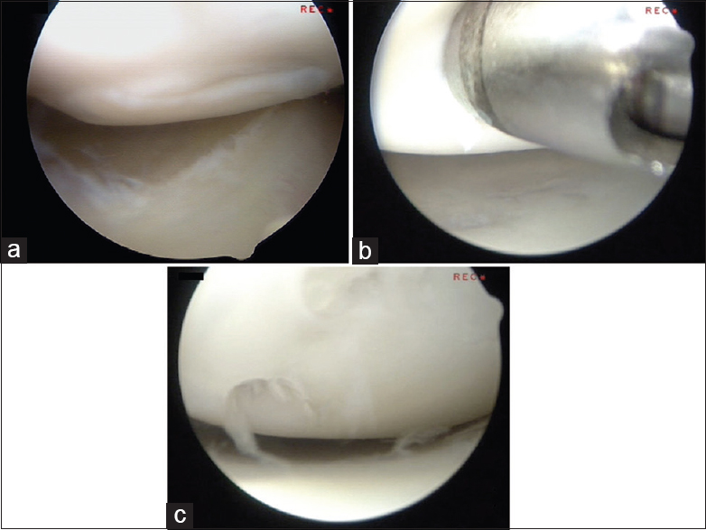 Figure 2: The arthroscopic findings. (a) The 2-cm osteochondral lesion can be distinguished from the other site, but the articular cartilage of the lesion maintains its continuity with the surrounding cartilage. (b) The lesion is obviously softened compared to the other area. Four absorbable threaded pins are inserted into the center area of the abnormal lesion. (c) The osteochondral fragment is fixed to the humeral head