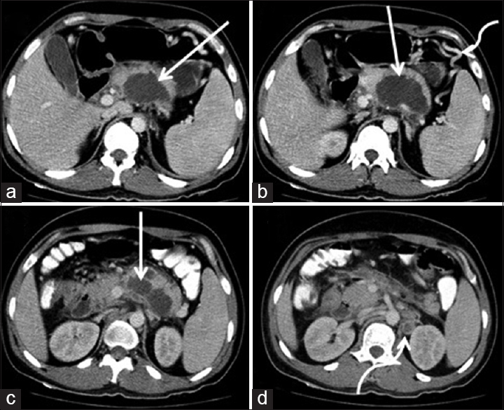 Figure 1: Axial section computed tomography demonstrates nonenhancing cystic lesion in the pancreas with ill-defined margins (straight white arrow a, b, and c). Enlarged lymph nodes in the left para-aortic region with central necrotic component (curved white arrow in d). Collateral vessels (curved white arrow in b) secondary to narrowing of splenic vein