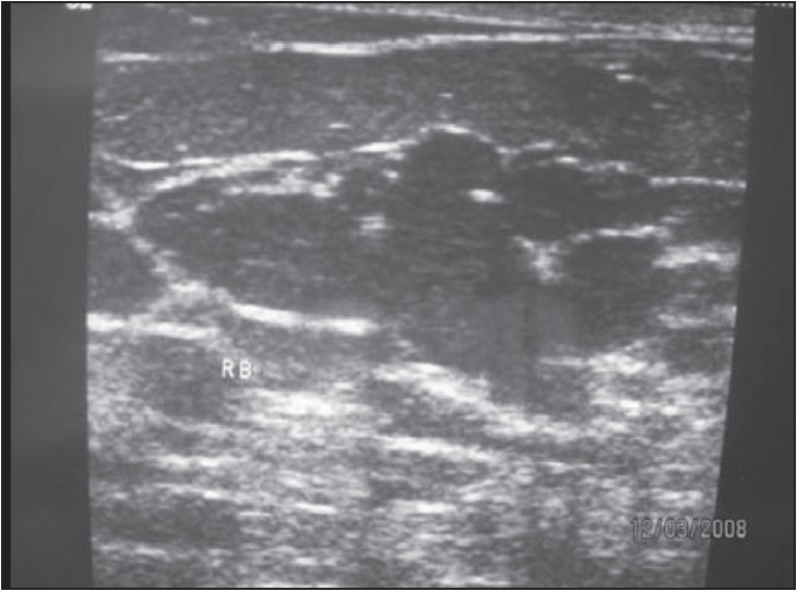 Figure 1: Right breast sonomammogram showing dilated lactiferous ducts